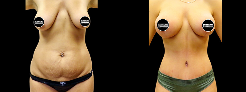 Liposuction Before & After Photos Patient 04