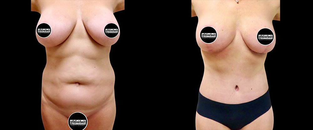 Abdominoplasty (Tummy Tuck) Before and After Examples