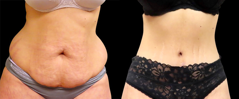 https://www.rottmanplasticsurgery.com/gallery/mini-tuck-and-tummy-tuck-(abdominoplasty)/06/01.jpg