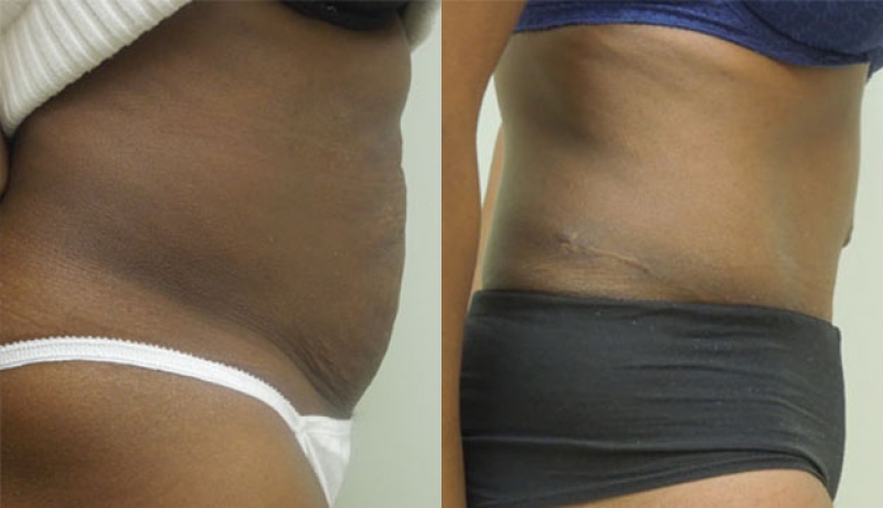 Abdominoplasty (Tummy Tuck) Before and After Pictures Case 306, Austin, TX