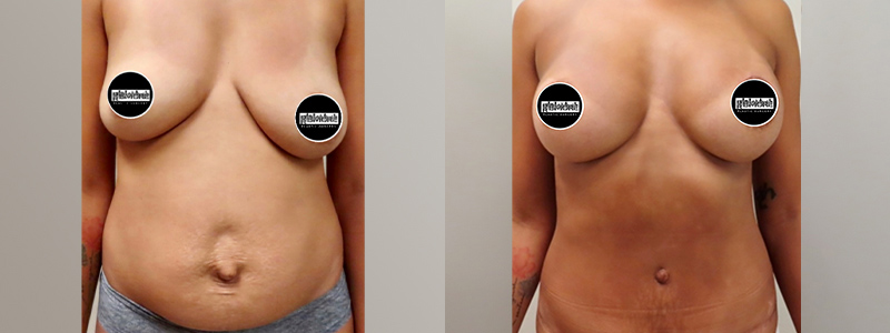 Mini Tuck And Tummy Tuck (abdominoplasty) Before & After Photos Patient 21