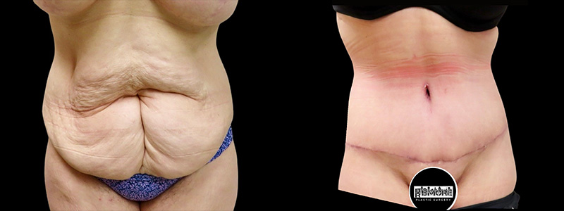 Mini Tuck And Tummy Tuck (abdominoplasty) Before & After Photos Patient 01