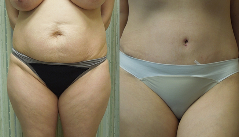 Mini Tummy Tuck Before and After Photos Case 19, Melbourne, FL